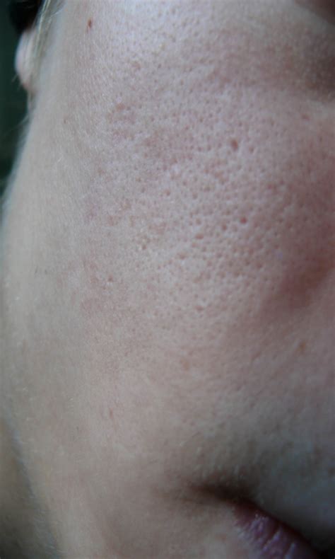 Scarred Pores Pic Help Scar Treatments Community