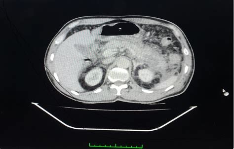 Contrast Enhanced Computed Tomography Of Abdomen Shows Pancreatic