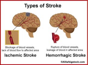 Image result for stroke