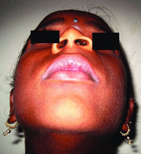 Submental View Photograph Showing Obvious Swelling On The Left Anterior