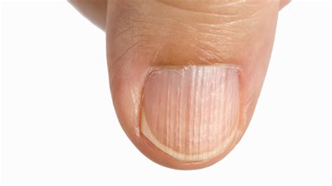 Black lines on finger nails, there are many reasons for this. What your nails reveal about your health - WSTale.com