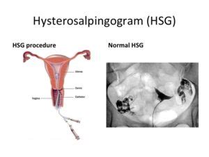 Gambar, video, tulisan, plugin, script. Hysterosalpingography - Fertility Centre Nepal