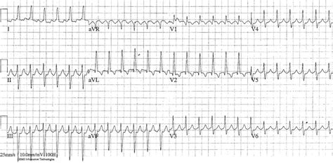 Ecg Atrial Flutter With 2 1 Block Images And Photos Finder