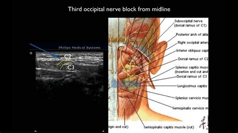 Ultrasound Guided Thrid Occipital Nerve Block Youtube