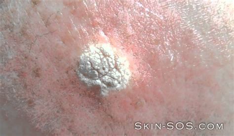 Keratosis Treatment How To Remove Keratosis Home Youtube