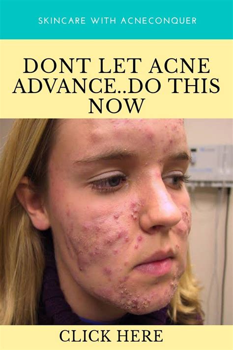 Dont Let Acne Advance Acne Acne Help Prevent Acne