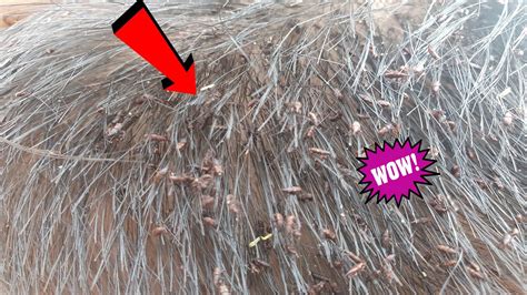 Big Lice Combing Remove Thousand Lice On Boy Head Youtube