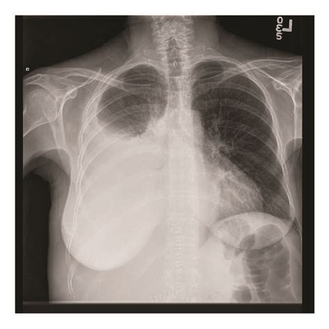 Chest X Rays With Chest Tube In Situ And After Removal Of Chest Tube