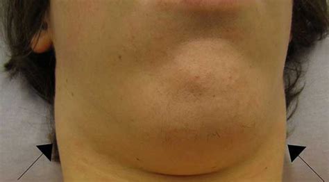 Lump Under Chin Causes Right Or Left Side Near