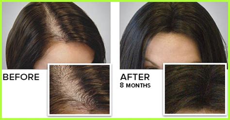 It is an essential nutrient which improves the hair follicles and cells read here to know how folic acid helps in hair growth and good sources of folic acid. Is iron and folic acid good for hair growth ...