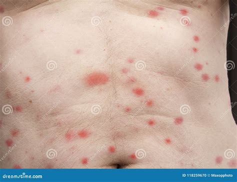 Bites Of Insect On Male Body Bed Bugs Or Flea Stock Photo Image Of