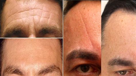 Get Rid Of Deep Forehead Wrinkles Naturally How To Get Rid Of