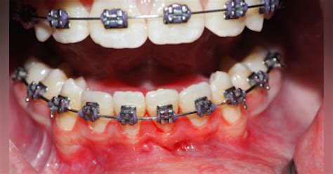 Bc Oral Pathology Case 40 The Empty Lesion Dentistry Iq