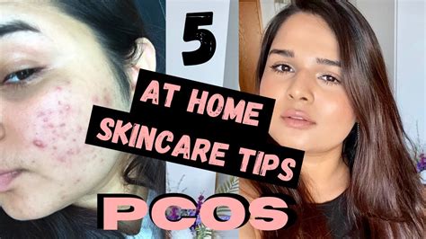 How To Get Rid Of Pcos Acne At Home 5 Tips That Actually Work Youtube