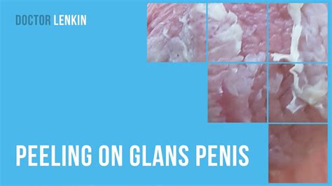 Peeling On Glans Penis Youtube