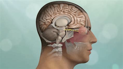 Complex Skull Base Tumors Symptoms And Treatment Polaris