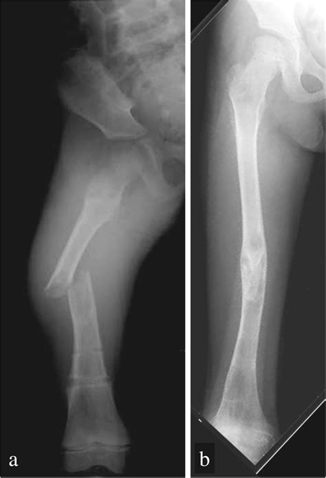 Pronounced Femur Malunion After Pathological Bone Fracture Due To A