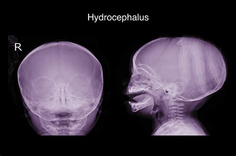 Hydrocephalus Water On The Brain Medlineplus