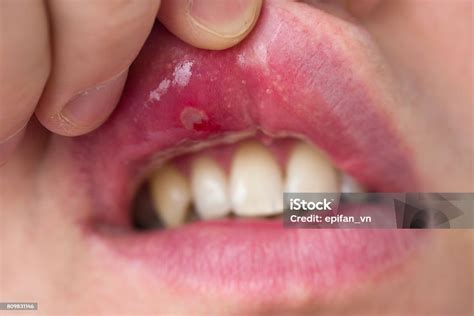 Closeup Of Stomatitis Into Mouth Stock Photo Download Image Now