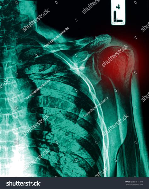 Shoulder Xray Image Showing Proximal Humeral Stock Photo
