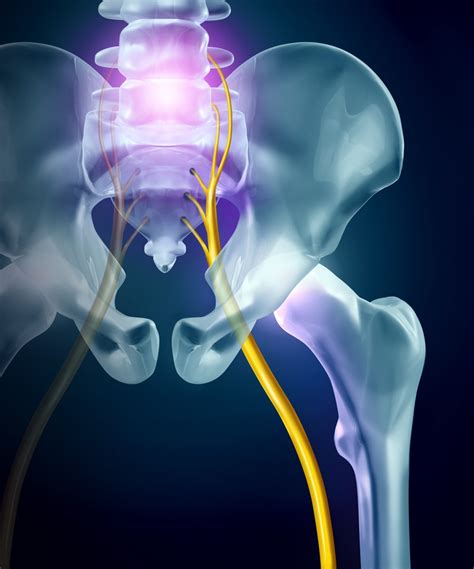 Relief Of Sciatica Pain Advanced Pain Management And Spine Specialists
