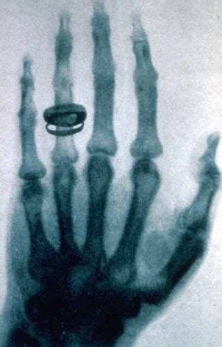 This Was The First Human X Ray Ever Taken History Hand Care