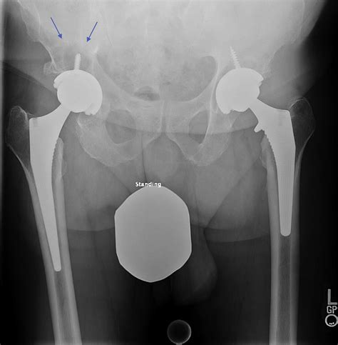 Example Of Osteolysis Anteroposterior Ap Pelvis Radiograph