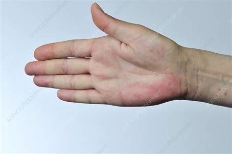 What Causes Red Spots On Palms Of Hands
