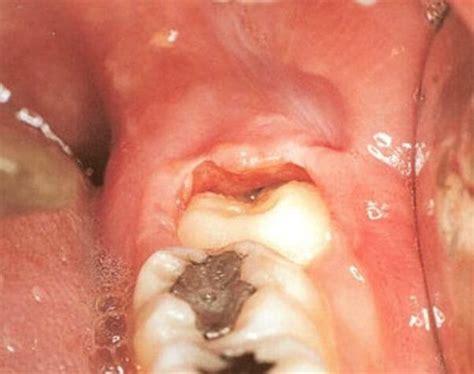 What Causes An Inflamed Gum Around My Wisdom Tooth Quora