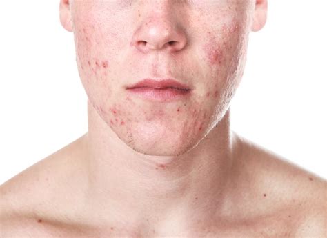 Skin Test Institute Acne Blemishes