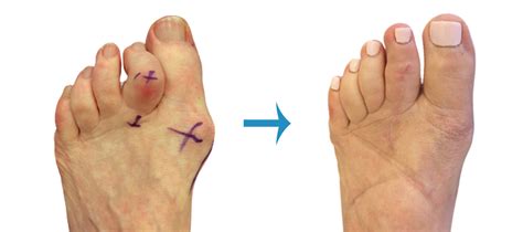 Before And After Foot Surgery Image Gallery London