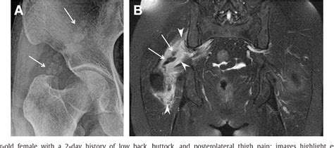 Figure 3 From Acute Calcific Tendinitis Of The Gluteus Medius An