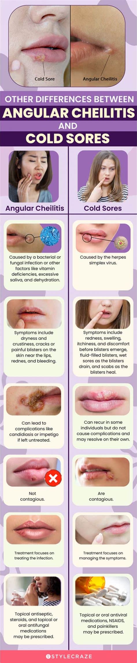 14 Remedies For Angular Cheilitis Stages Causes And Prevention
