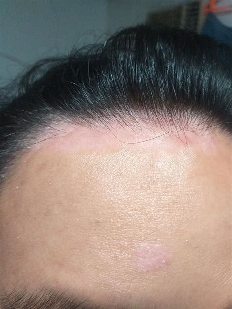 Tips For Scalp Psoriasis Exceeding Hairline Rpsoriasis