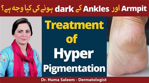 Treatment Of Hyperpigmentation Dark Armpit Aur Ankles Causes In Urdu