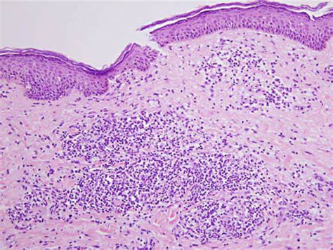 Histopathology Reveals Multiple Non Caseous Epithelioid Cell Granulomas