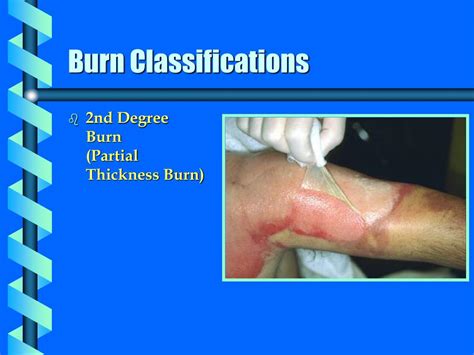 Ppt Burn Injuries Powerpoint Presentation Free Download Id917172