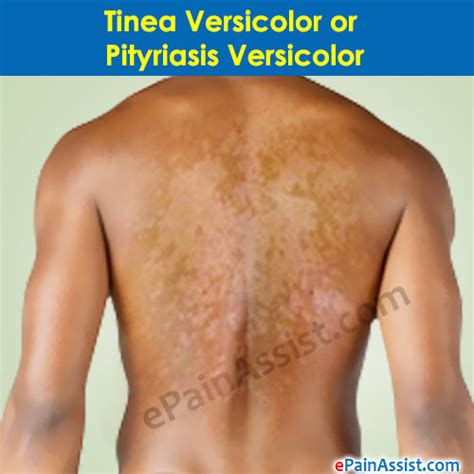 Pityriasis Versicolor Pictures Photos