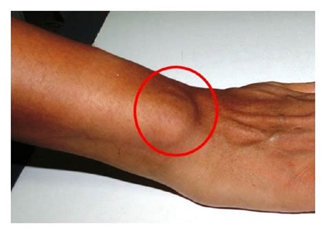 Showing Presence Of Nodules At The Right Wrist Joint On Lateral Aspect