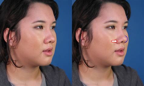 Asian Rhinoplasty Nose Job Surgery By Expert Ethnic Nose Surgeon Dr
