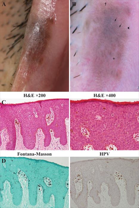 Jle European Journal Of Dermatology Dermoscopic Findings In