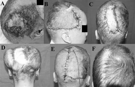 Reconstruction Of Post Traumatic Losses Of Substance Of The Scalp Our