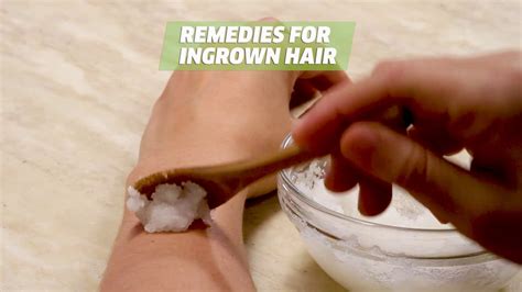 How To Get Rid Of And Remove Ingrown Hair Easy Youtube