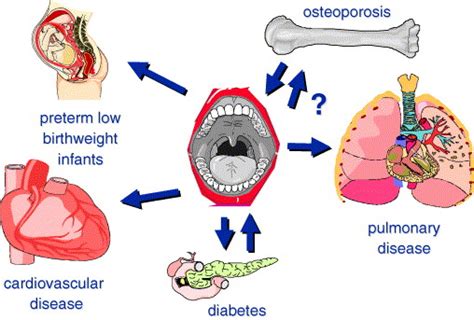 Systemic Effects Of Periodontal Diseases Dental Clinics