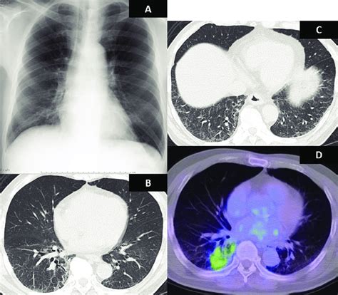 A Chest Radiograph Showed A Reticular Shadow In The Right Lower Area