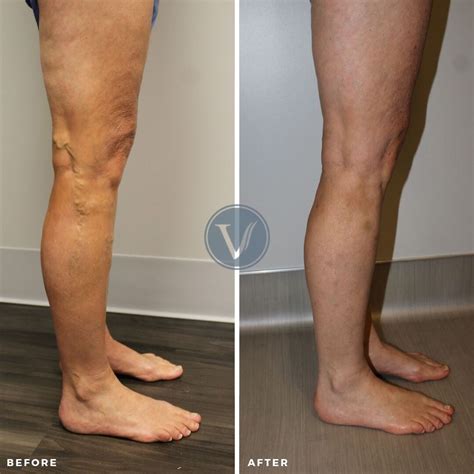 Removing Painful Varicose Veins With Endovenous Ablation Treatment