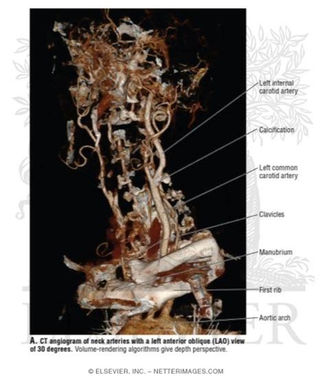 Blood is carried to the brain through blood vessels called arteries. CT Angiogram of Neck Arteries With a Left Anterior Oblique ...