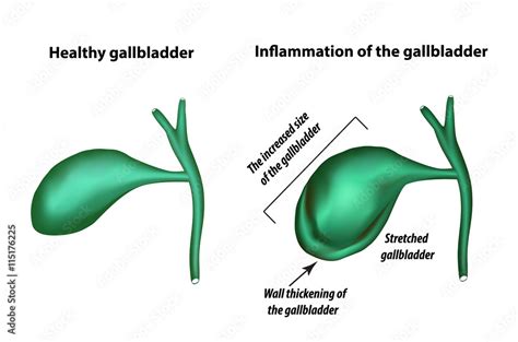 Symptoms Of Gallbladder Inflammation Cholecystitis Thickening Of The