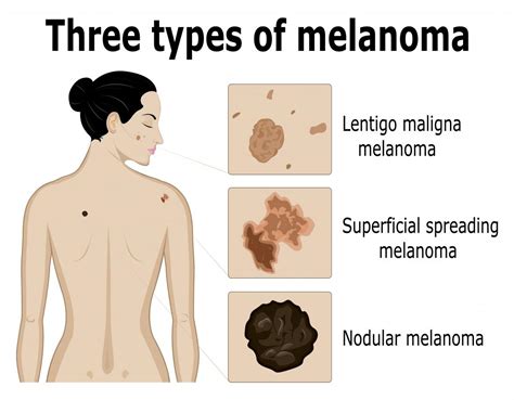 Какво трябва да знаете за меланома BGMedBook