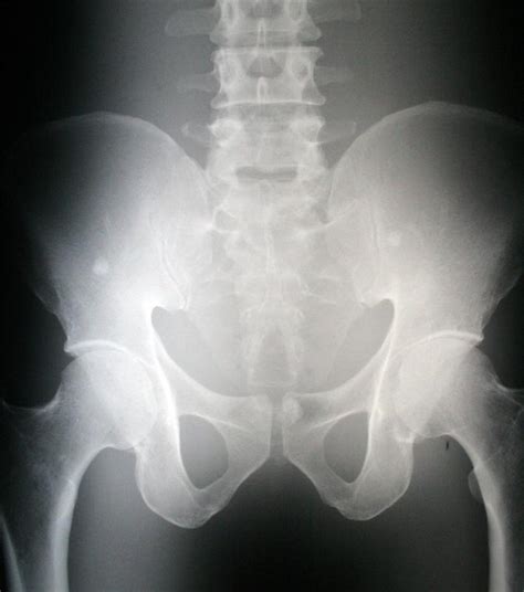 What Is The Anatomy Of The Hip With Pictures